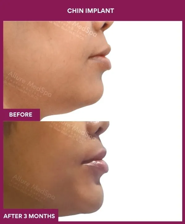 chin-augmentation-surgery-before-after-results-mumbai-india-patient18-side-right