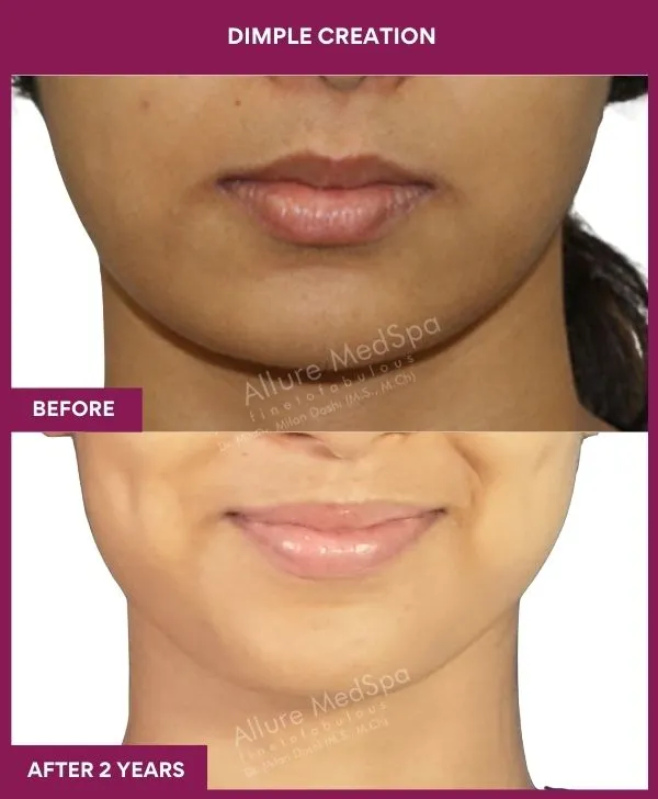 dimple-creation-surgery-before-after-results-mumbai-india-patient01-front