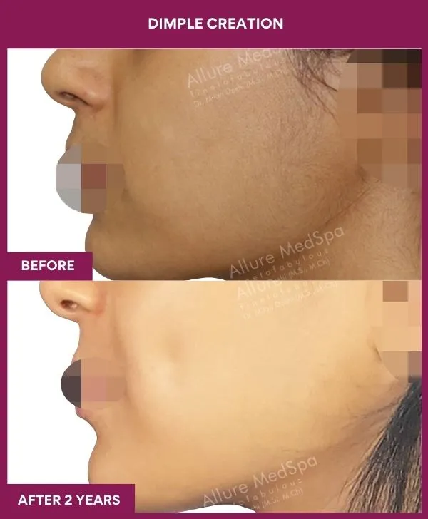 dimple-creation-surgery-before-after-results-mumbai-india-patient01-side-left