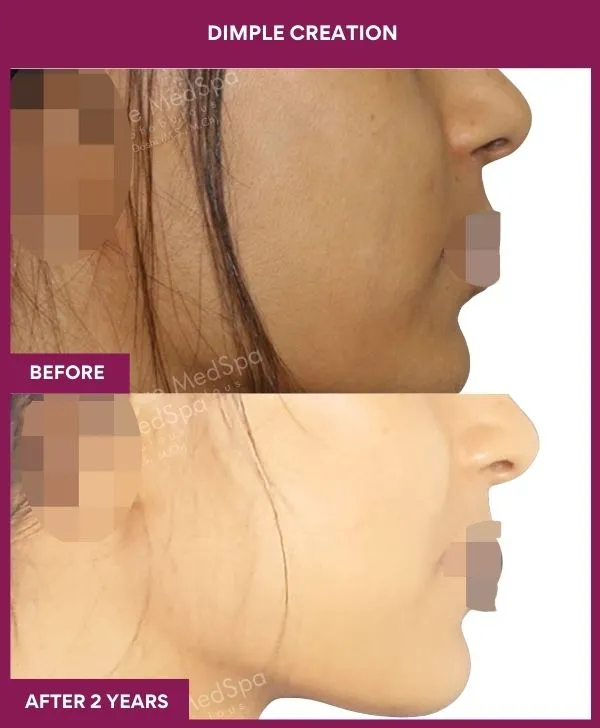 dimple-creation-surgery-before-after-results-mumbai-india-patient01-side-right