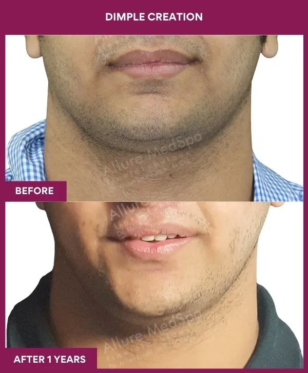 dimple-creation-surgery-before-after-results-mumbai-india-patient02-front