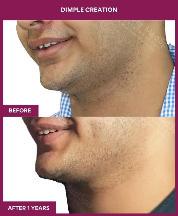 dimple-creation-surgery-before-after-results-mumbai-india-patient02-side-left