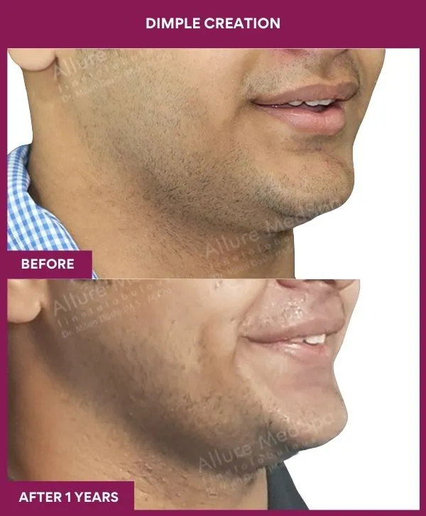 dimple-creation-surgery-before-after-results-mumbai-india-patient02-side-right
