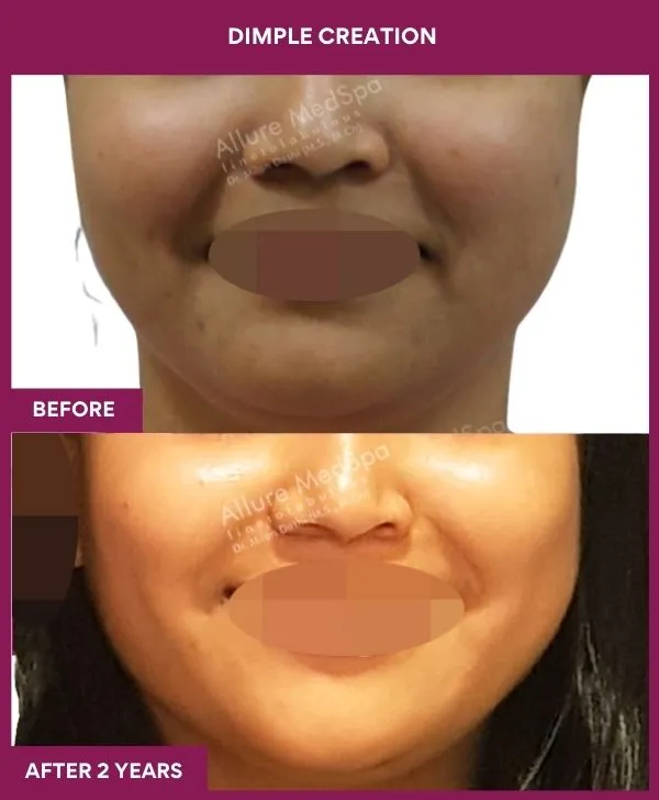 dimple-creation-surgery-before-after-results-mumbai-india-patient03-front