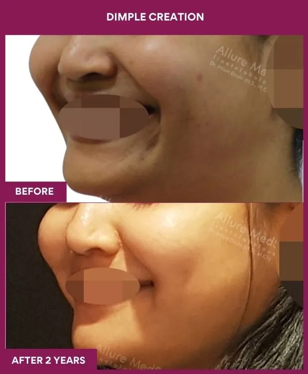 dimple-creation-surgery-before-after-results-mumbai-india-patient03-side-left
