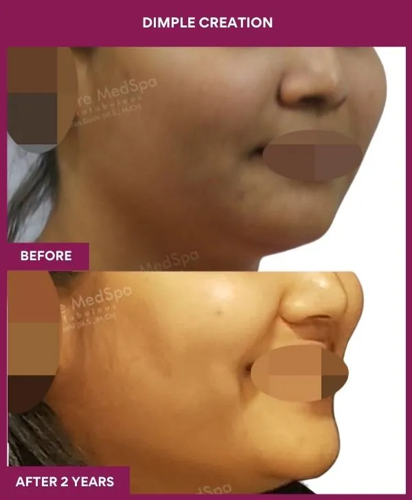 dimple-creation-surgery-before-after-results-mumbai-india-patient03-side-right