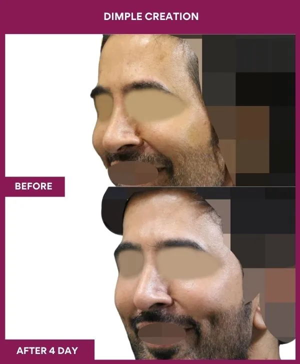 dimple-creation-surgery-before-after-results-mumbai-india-patient04-front-right
