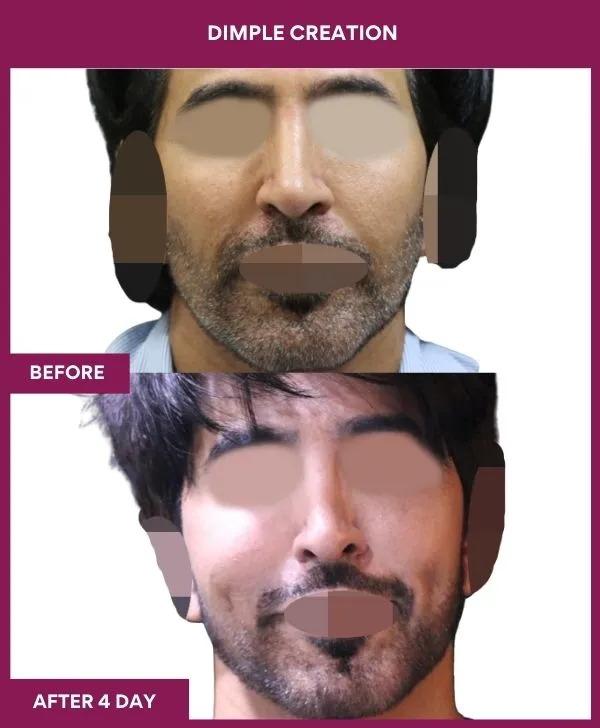 dimple-creation-surgery-before-after-results-mumbai-india-patient04-front