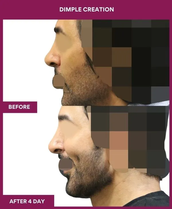 dimple-creation-surgery-before-after-results-mumbai-india-patient04-side-right