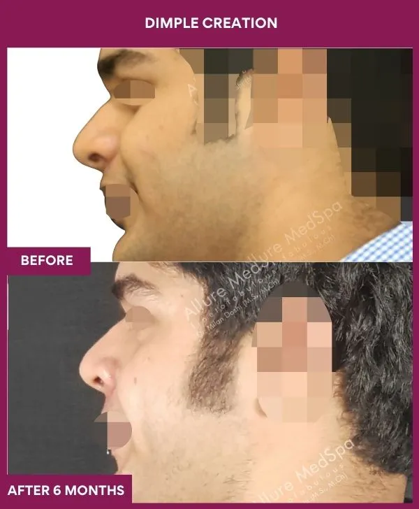 dimple-creation-surgery-before-after-results-mumbai-india-patient05-side-left