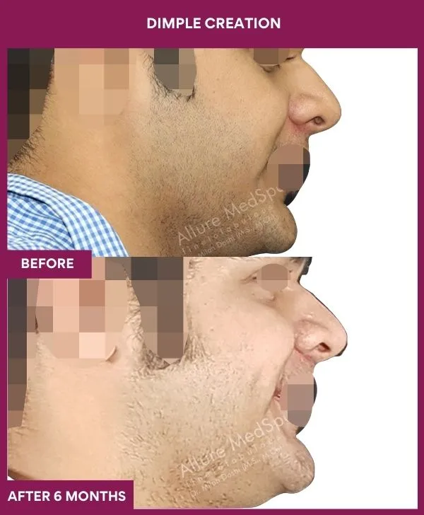 dimple-creation-surgery-before-after-results-mumbai-india-patient05-side-right
