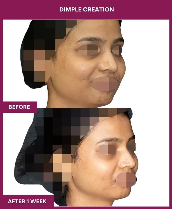 dimple-creation-surgery-before-after-results-mumbai-india-patient06-front-right