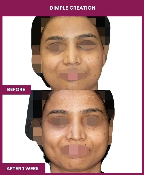 dimple-creation-surgery-before-after-results-mumbai-india-patient06-front