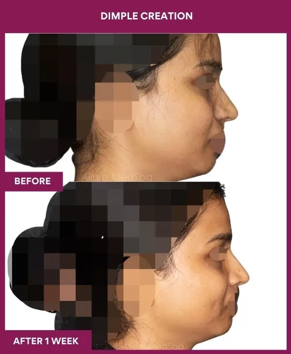 dimple-creation-surgery-before-after-results-mumbai-india-patient06-side-right