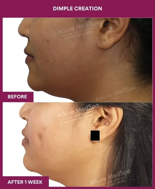 dimple-creation-surgery-before-after-results-mumbai-india-patient07-side-left