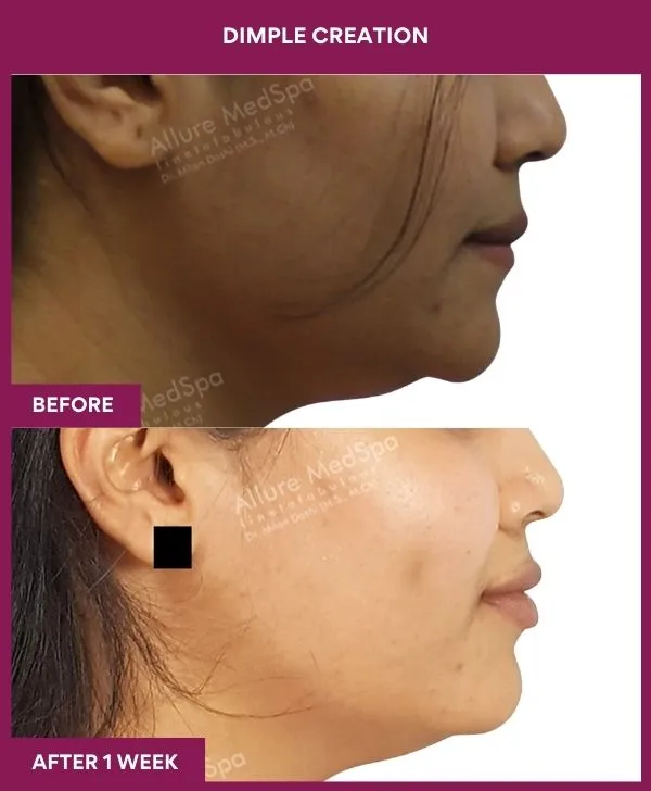 dimple-creation-surgery-before-after-results-mumbai-india-patient07-side-right