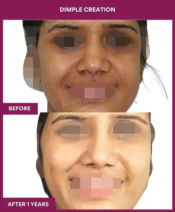 dimple-creation-surgery-before-after-results-mumbai-india-patient08-front