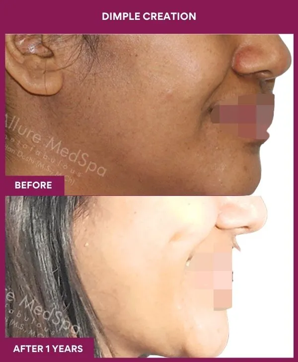 dimple-creation-surgery-before-after-results-mumbai-india-patient08-side-right