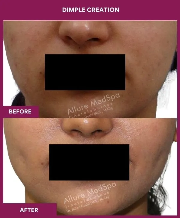 dimple-creation-surgery-before-after-results-mumbai-india-patient09-front