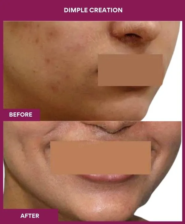 dimple-creation-surgery-before-after-results-mumbai-india-patient09-side-right