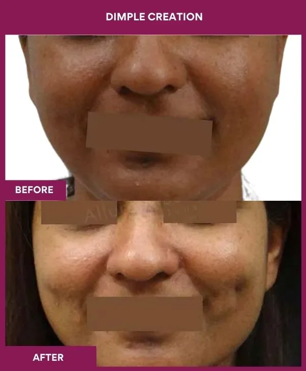 dimple-creation-surgery-before-after-results-mumbai-india-patient10-front
