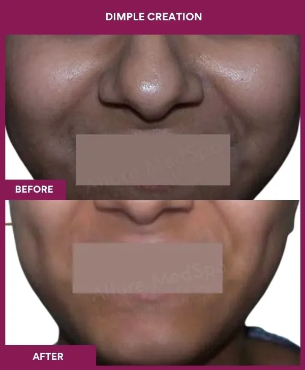 dimple-creation-surgery-before-after-results-mumbai-india-patient11-front