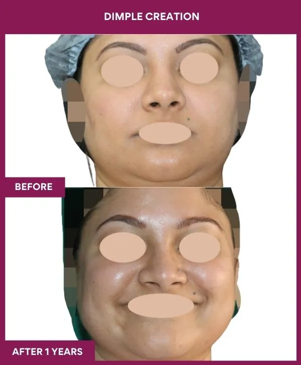 dimple-creation-surgery-before-after-results-mumbai-india-patient12-front