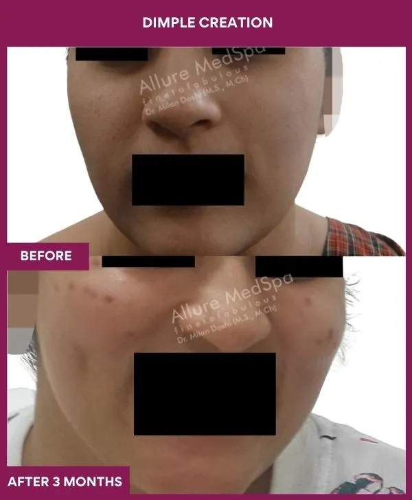 dimple-creation-surgery-before-after-results-mumbai-india-patient13-front