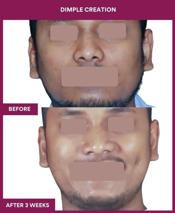 dimple-creation-surgery-before-after-results-mumbai-india-patient14-front
