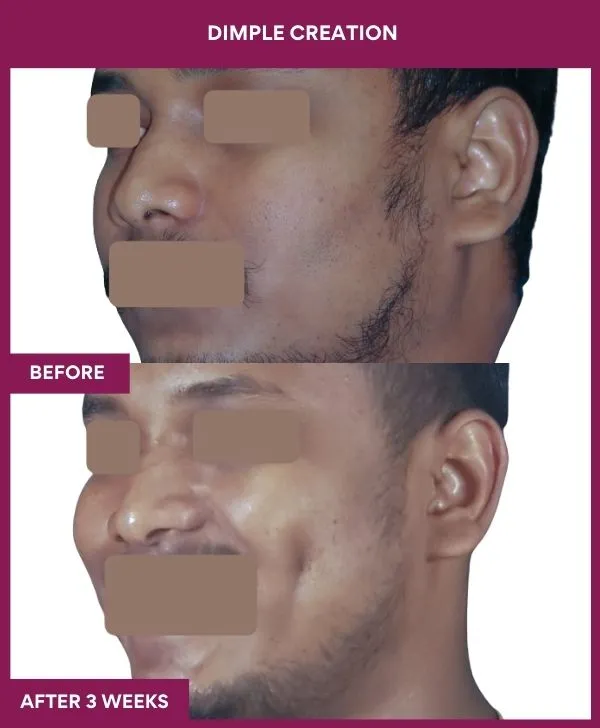 dimple-creation-surgery-before-after-results-mumbai-india-patient14-side-left