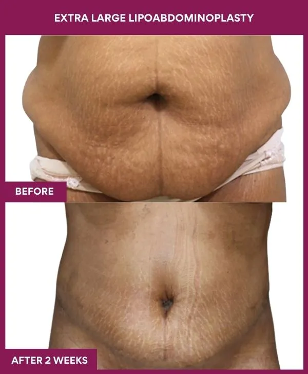 extra-large-female-lipoabdominoplasty-before-after-results-mumbai-india-patient02-front