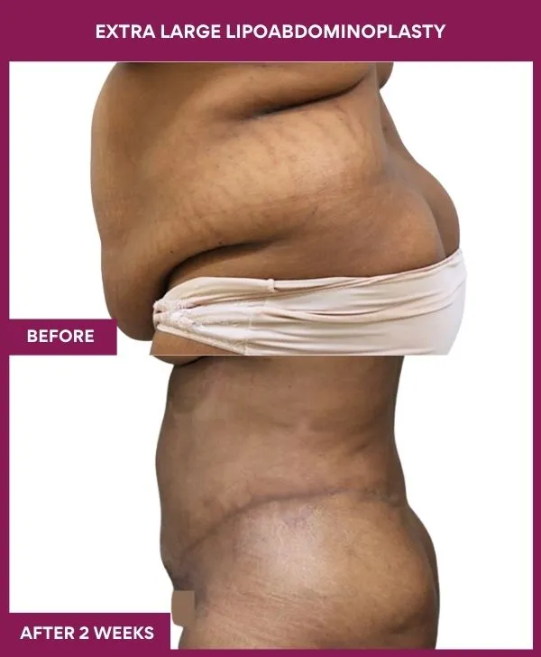 extra-large-female-lipoabdominoplasty-before-after-results-mumbai-india-patient02-side-left