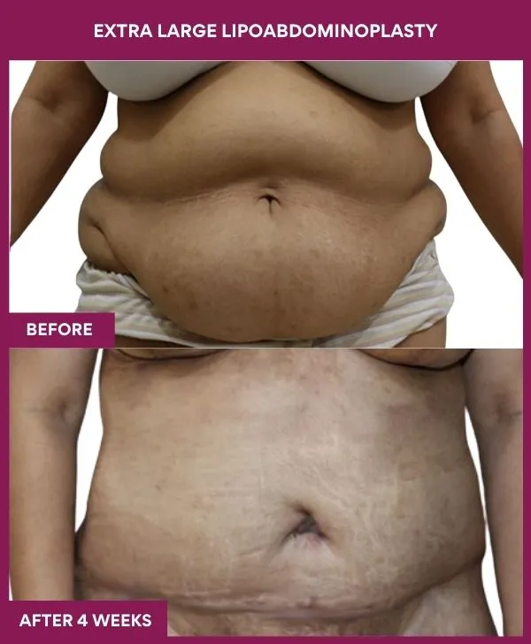 extra-large-female-lipoabdominoplasty-before-after-results-mumbai-india-patient03-front