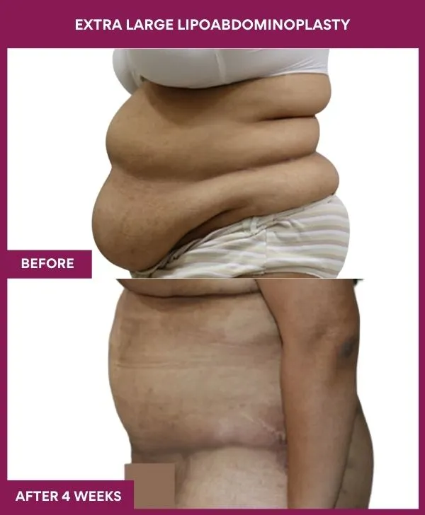 extra-large-female-lipoabdominoplasty-before-after-results-mumbai-india-patient03-side-left