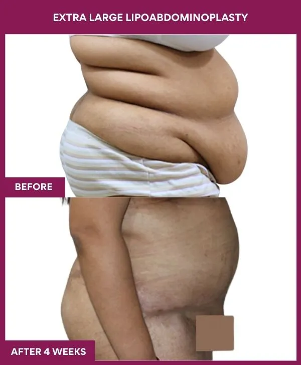 extra-large-female-lipoabdominoplasty-before-after-results-mumbai-india-patient03-side-right