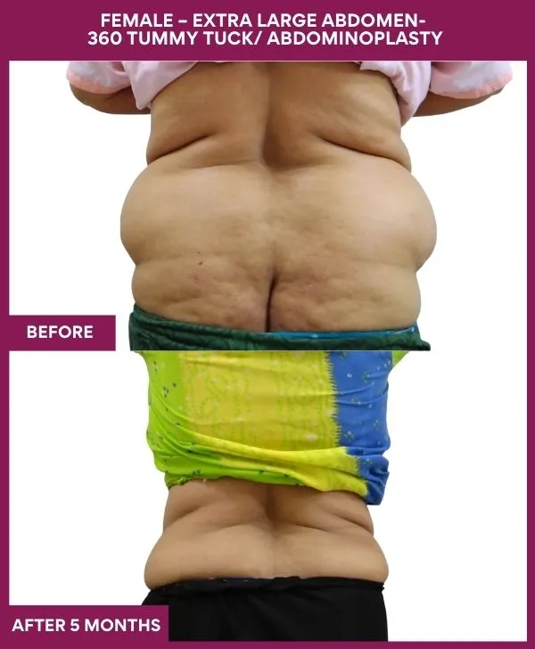 extra-large-female-lipoabdominoplasty-before-after-results-mumbai-india-patient04-back