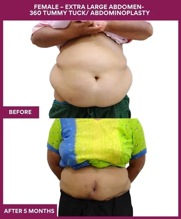extra-large-female-lipoabdominoplasty-before-after-results-mumbai-india-patient04-front