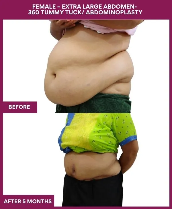 extra-large-female-lipoabdominoplasty-before-after-results-mumbai-india-patient04-side-left