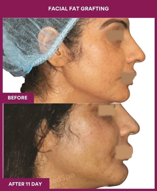 Fat Injection in Mumbai – 3200+ Happy Natural Enhancements by Dr. Milan Doshi