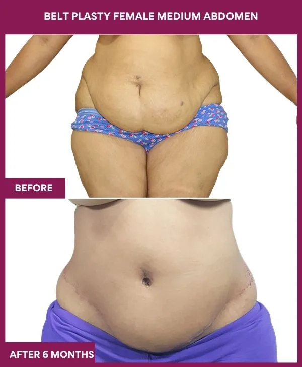 female-belt-lipectomy-before-after-results-mumbai-india-patient01-front