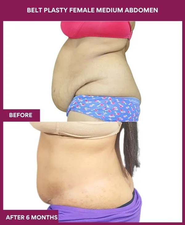 female-belt-lipectomy-before-after-results-mumbai-india-patient01-side-left