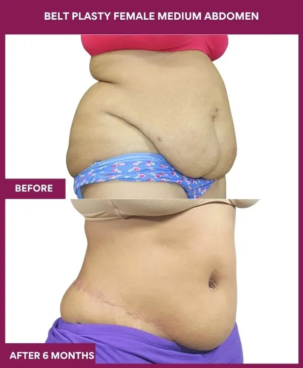 female-belt-lipectomy-before-after-results-mumbai-india-patient01-side-right