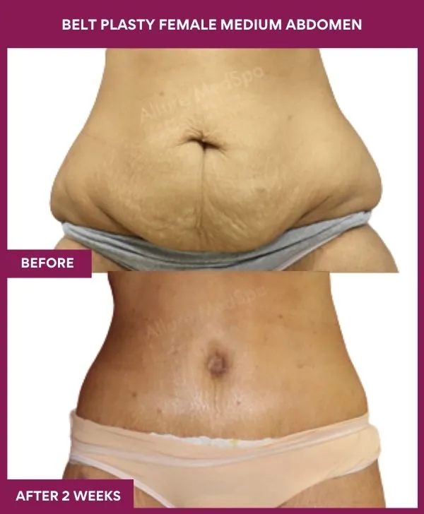 female-belt-lipectomy-before-after-results-mumbai-india-patient02-front