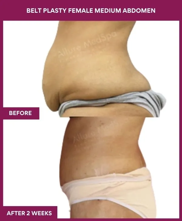 female-belt-lipectomy-before-after-results-mumbai-india-patient02-side-left
