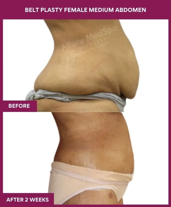 female-belt-lipectomy-before-after-results-mumbai-india-patient02-side-right