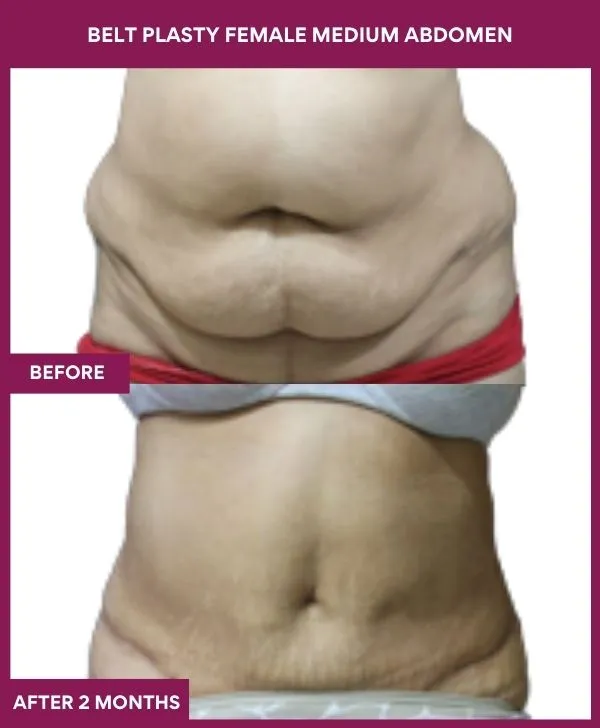 female-belt-lipectomy-before-after-results-mumbai-india-patient03-front