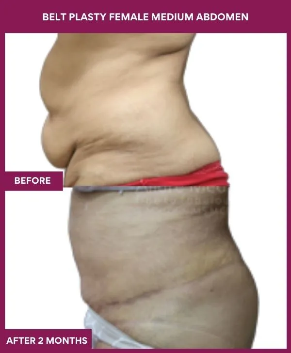 female-belt-lipectomy-before-after-results-mumbai-india-patient03-side-left