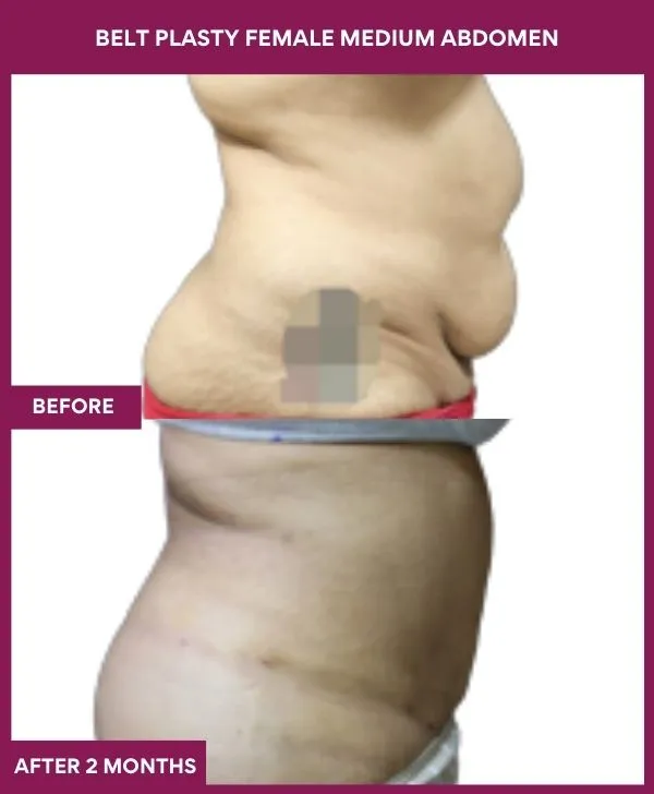 female-belt-lipectomy-before-after-results-mumbai-india-patient03-side