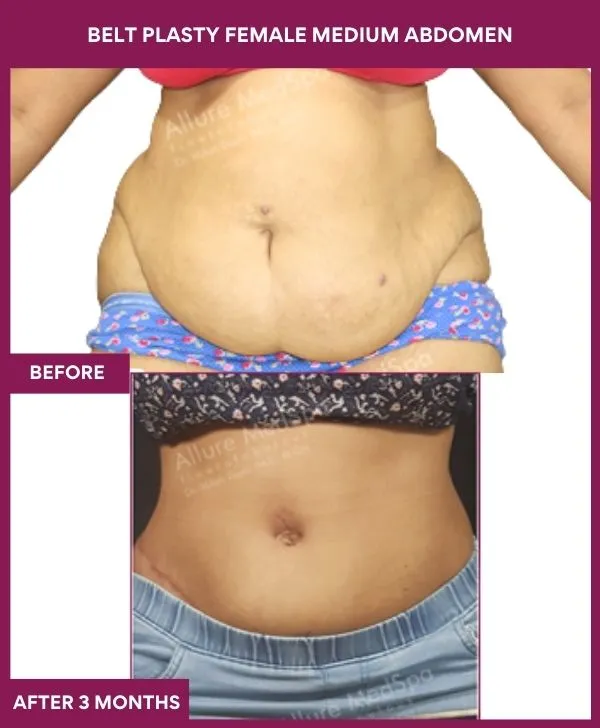 female-belt-lipectomy-before-after-results-mumbai-india-patient04-front