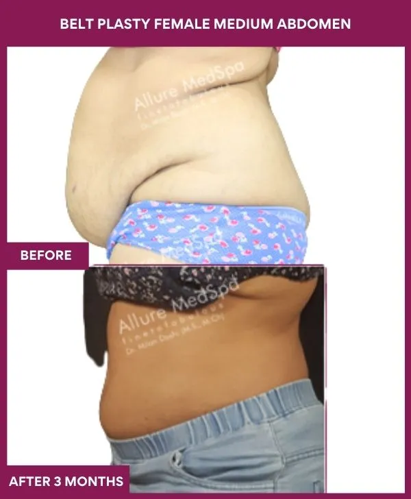 female-belt-lipectomy-before-after-results-mumbai-india-patient04-side-left